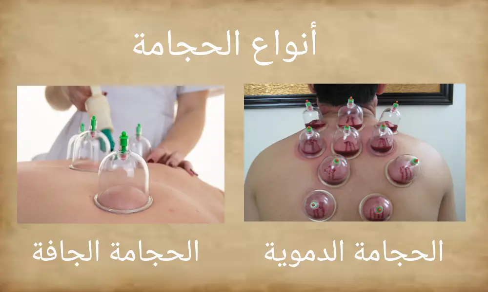 افضل اماكن الحجامة بالجسم بالصور 1 افضل اماكن الحجامة بالجسم