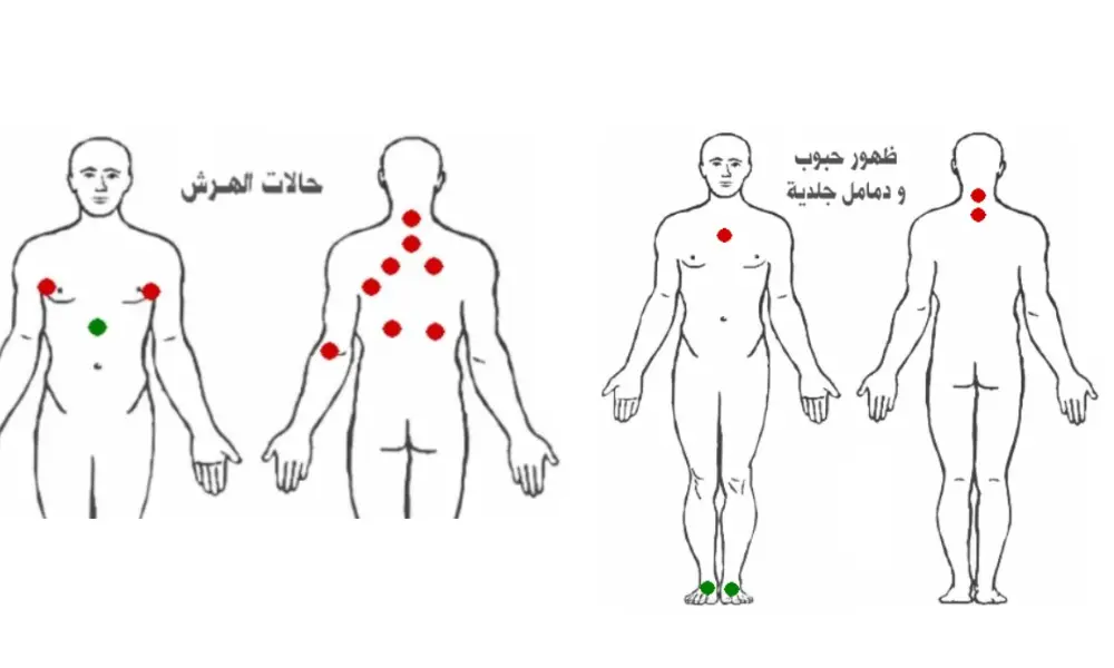 افضل اماكن الحجامة بالجسم بالصور 7 افضل اماكن الحجامة بالجسم