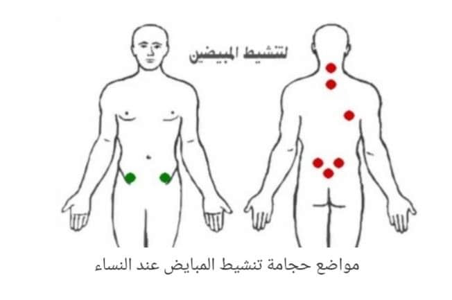 افضل اماكن الحجامة بالجسم بالصور 6 افضل اماكن الحجامة بالجسم بالصور